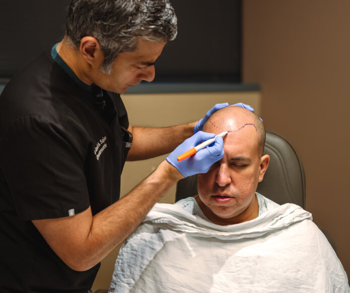 Techniques For Hairline Lowering