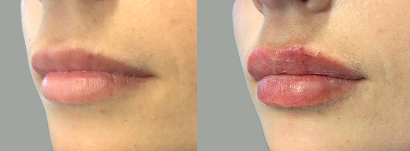 Lip Filler Allure 04