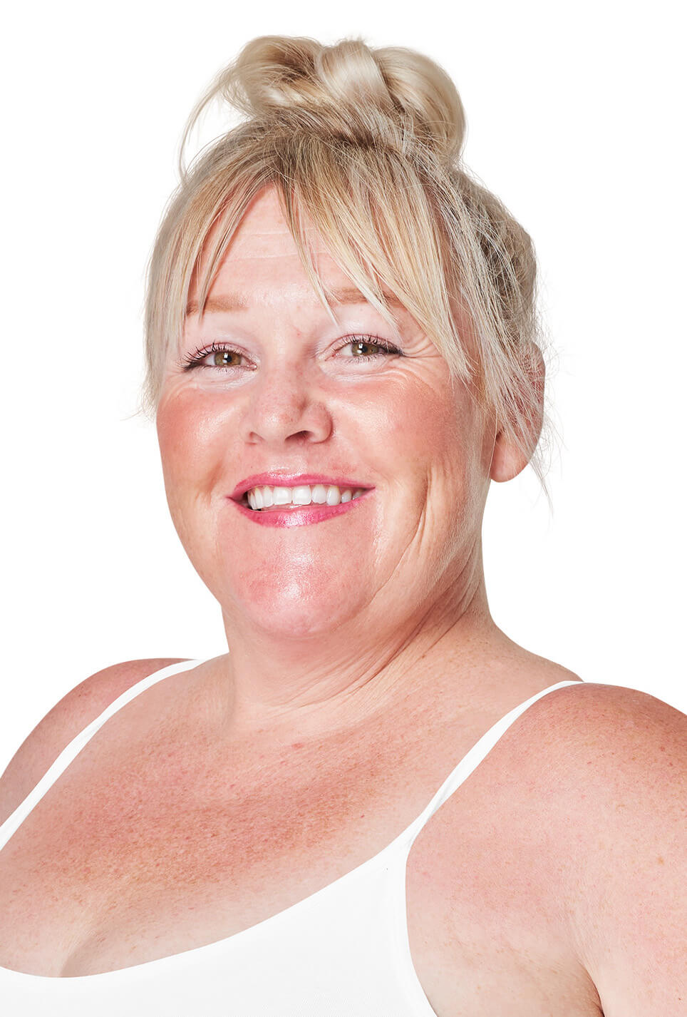 Lower Face Liposuction 003