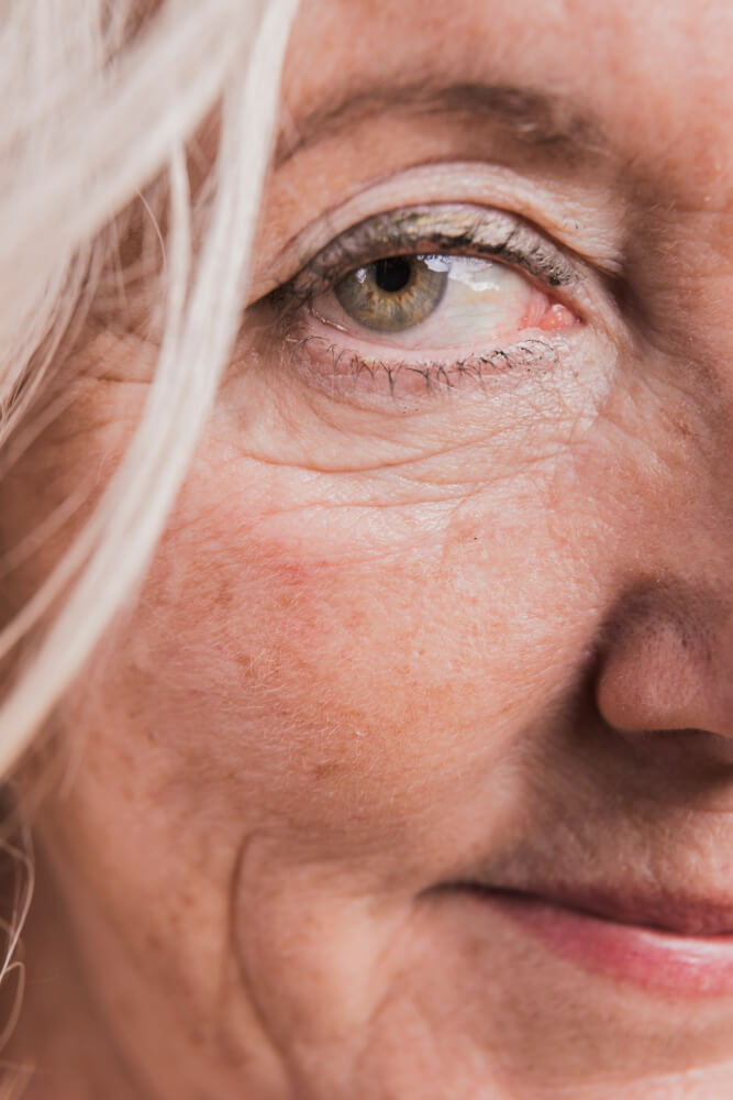 Nano Fat Transfer For The Under Eyes 02