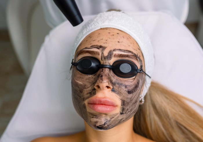 Laser Carbon Peel 02