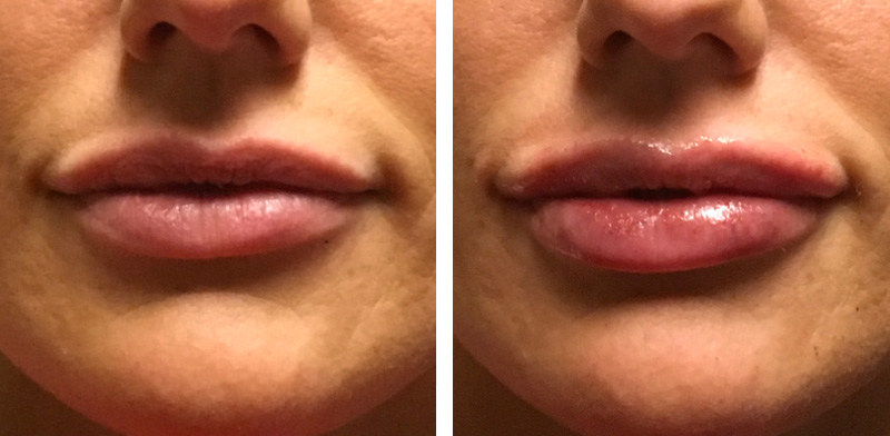 Juvederm Voluma Drsajan