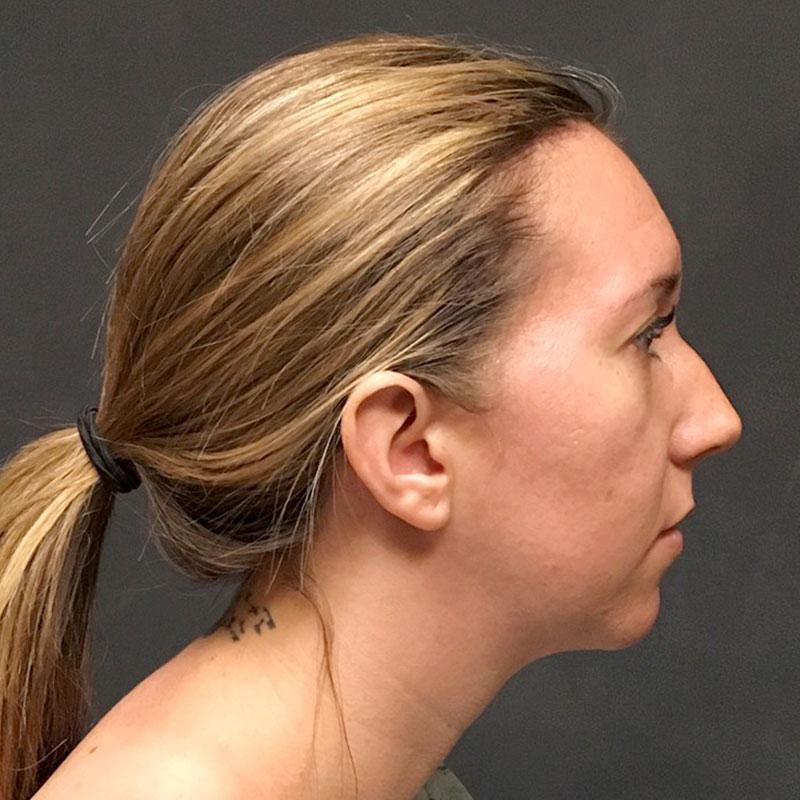 Chin Augmentation  Before & After