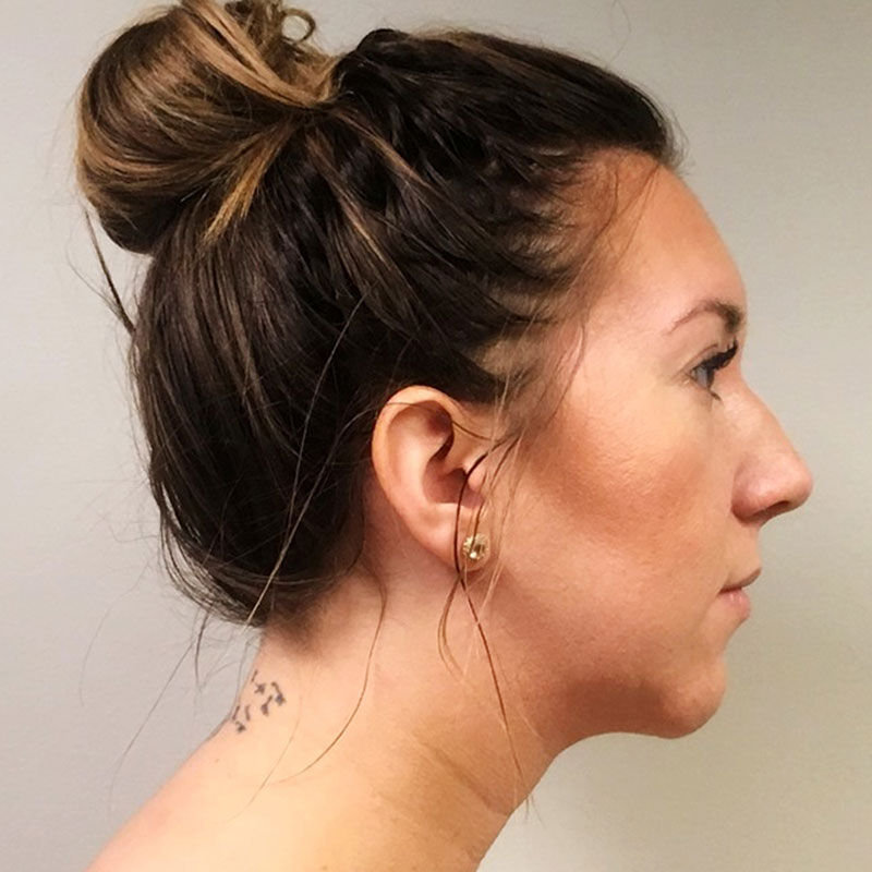 Chin Augmentation  Before & After