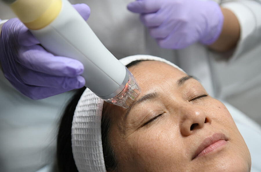 Cutera Secret RF Microneedling 01