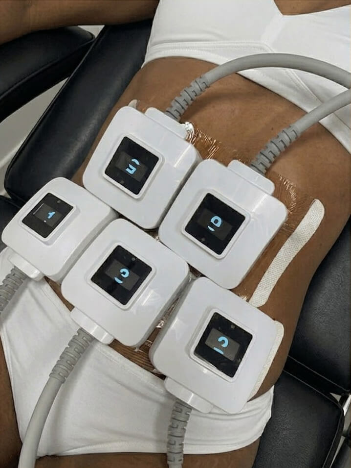 What areas can be Treated With Cutera truSculpt iD?