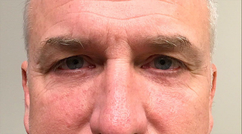 Blepharoplasty Before & After