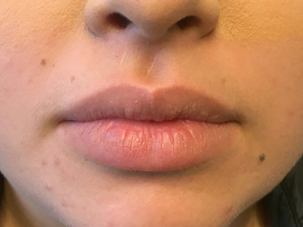 Lip Augmentation Seattle - Before