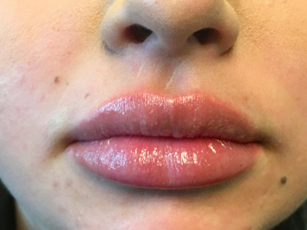 Lip Augmentation Seattle - After