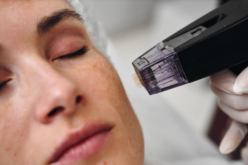Benefits of Combining Microneedling with Rejuran