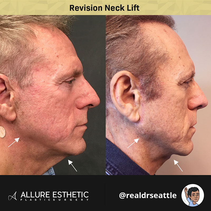 Seattle Facelift - Sam Naficy, MD - Face lift, Neck lift, Eyelid lift, Brow  lift in Seattle, WA