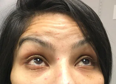 Botox After