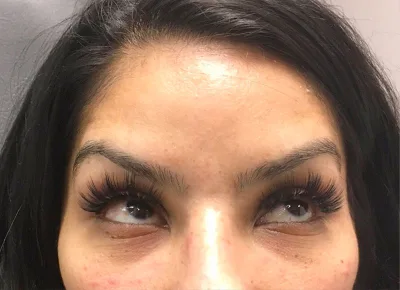 Botox Before