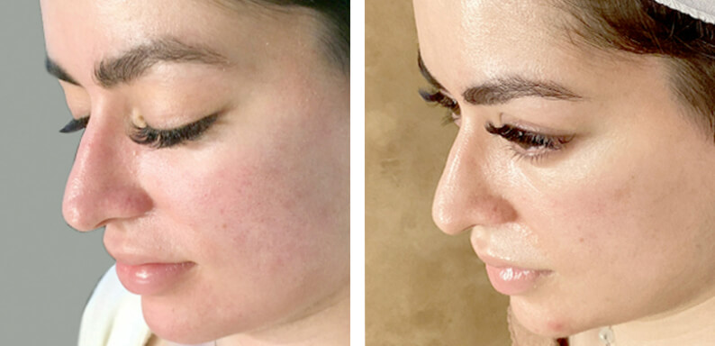 Chemical Peels Before After 02