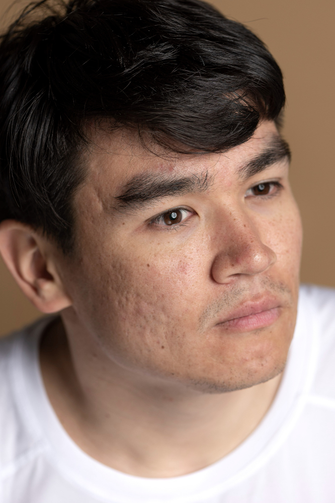 What Is Laser Resurfacing