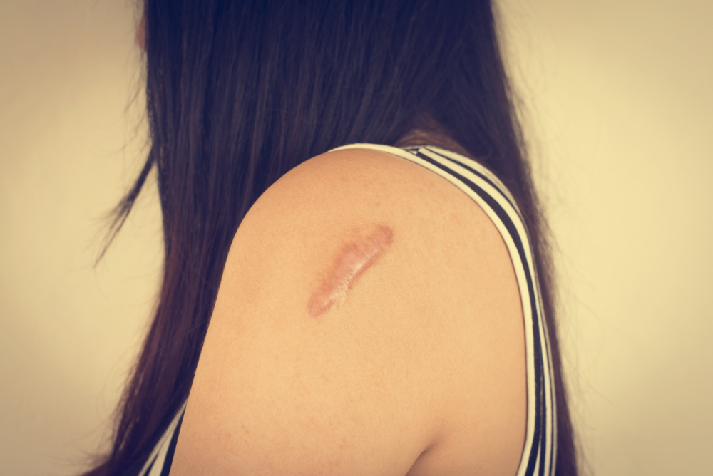 Your Laser Scar Resurfacing Treatment In Seattle