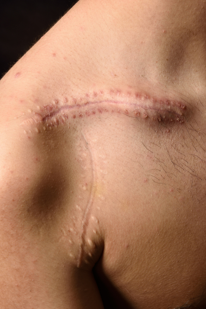 How Can Laser Resurfacing Improve The Appearance Of Scars