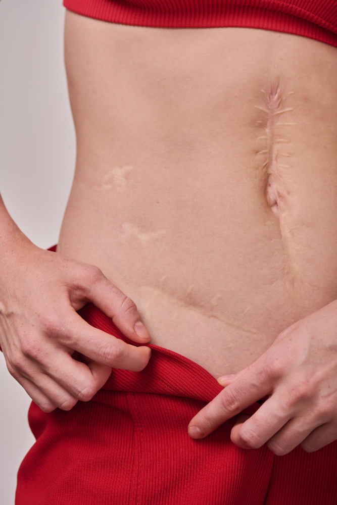 What Scars Can Laser Resurfacing Treat