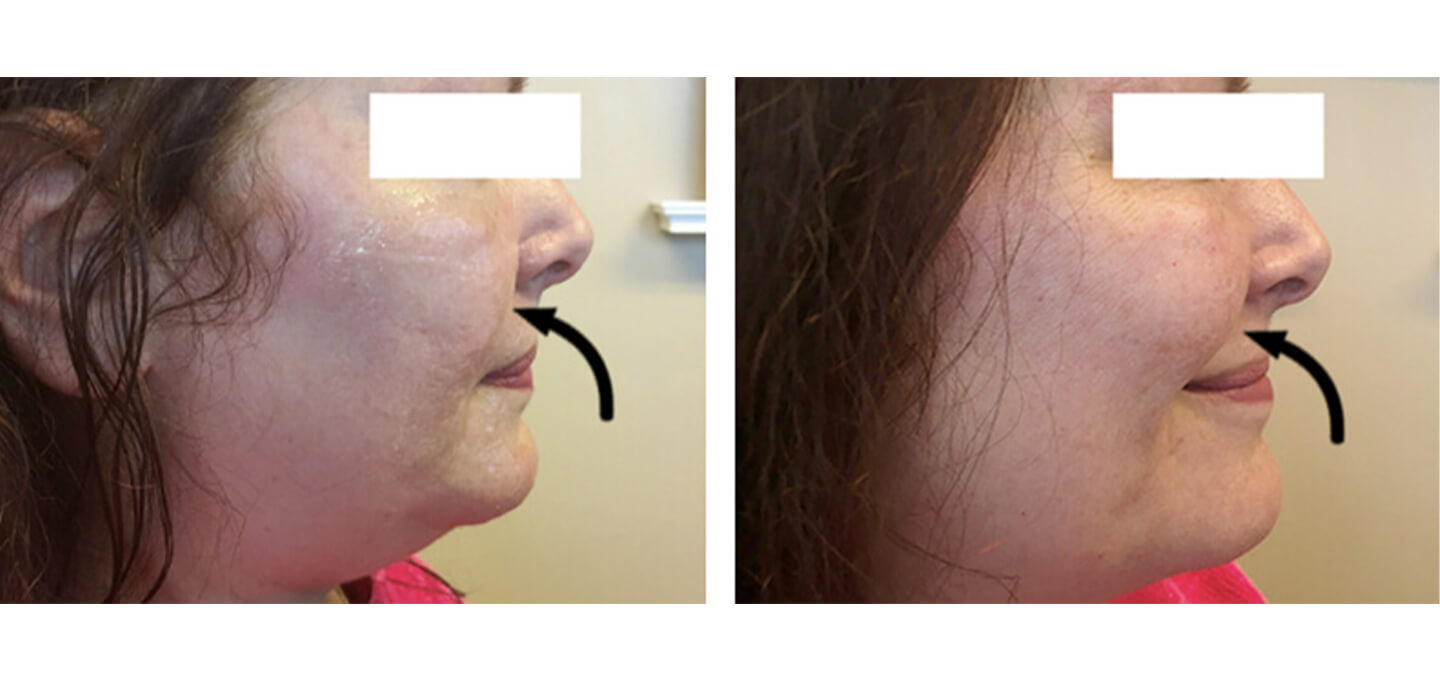 Cheek Filler Ba