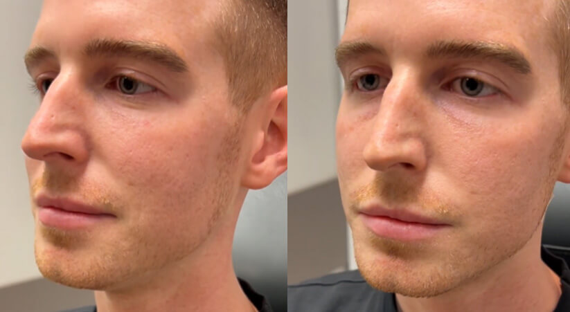 Pdo Thread Lifts Before After