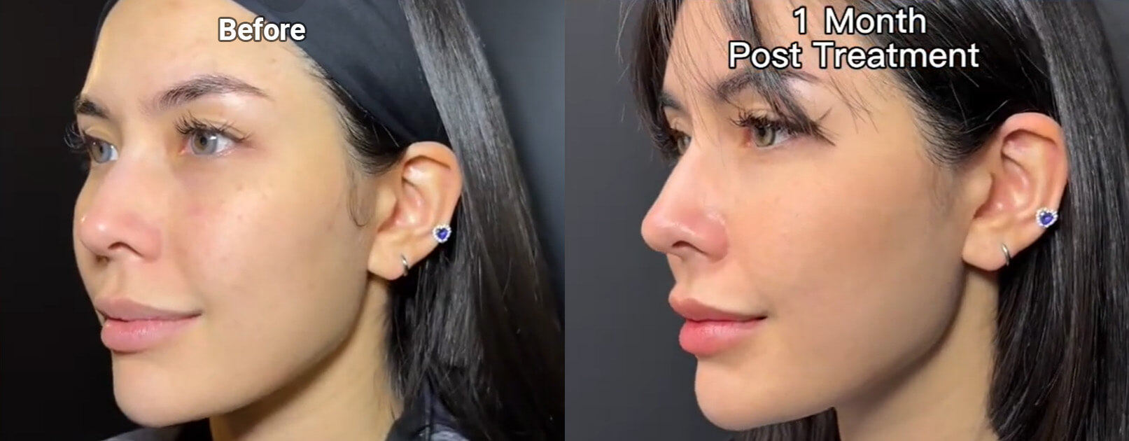 Salmon Sperm Facial Injection Before After