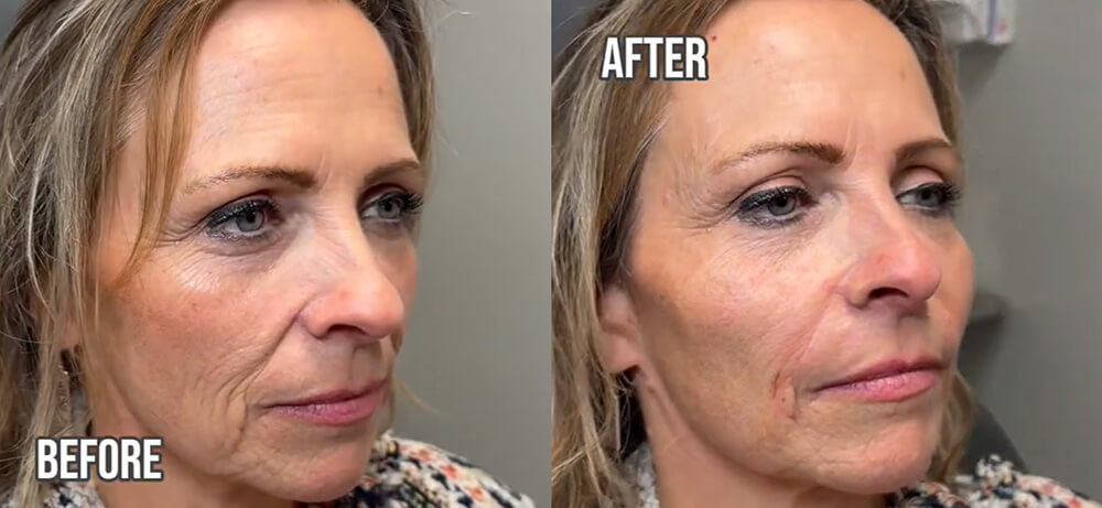 Sculptra Before After