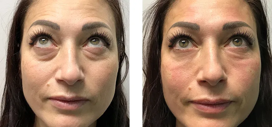 Skin Botox Before and After Results