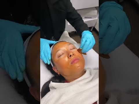 VI Peel Procedure