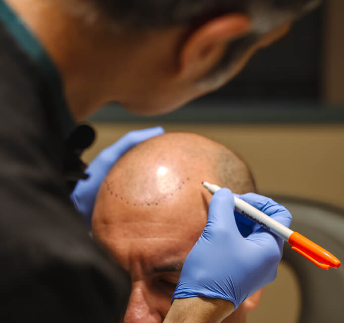 Dr.Sajan&rsquo;s Advanced Hair Transplantation Results