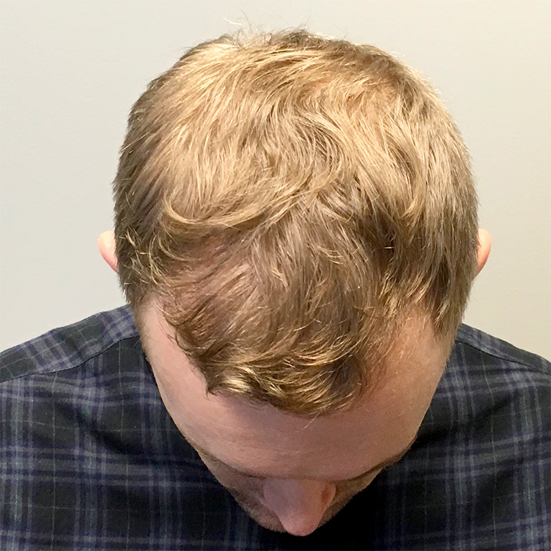 Fue Hair Treatment Seattle | Allure Esthetic