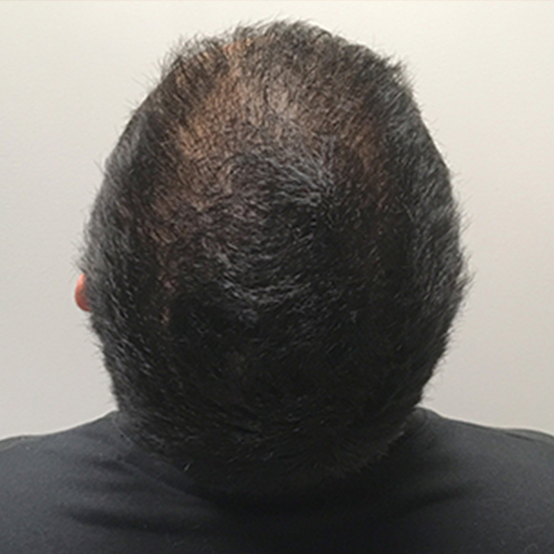 PRP Hair Treatment Seattle | Allure Esthetic