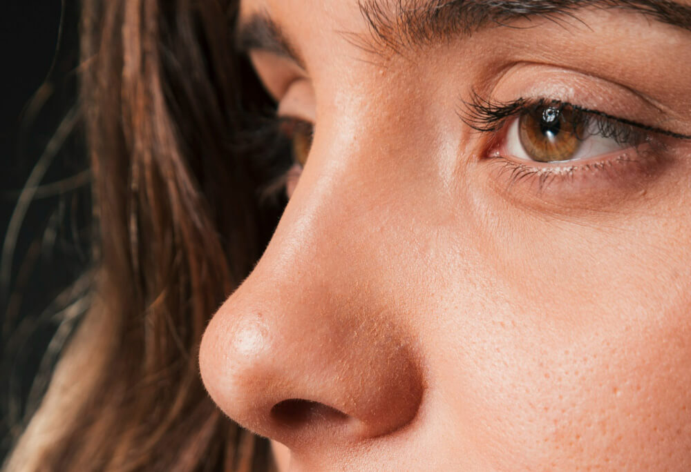 Closed Rhinoplasty 02