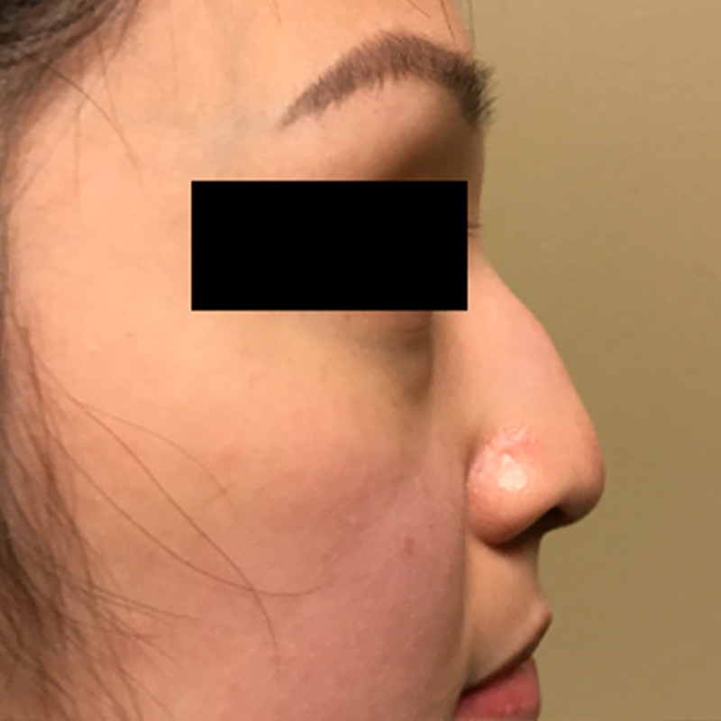 Ethnic Rhinoplasty Before 