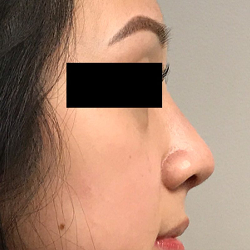 Ethnic Rhinoplasty After 