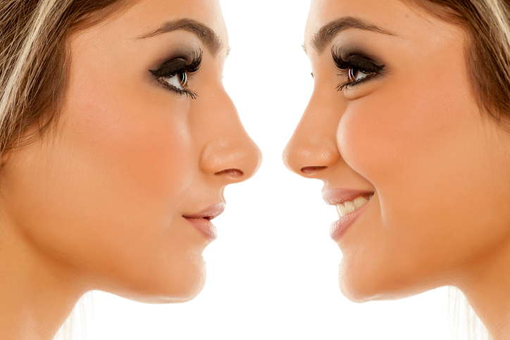 Rhinoplasty Seattle