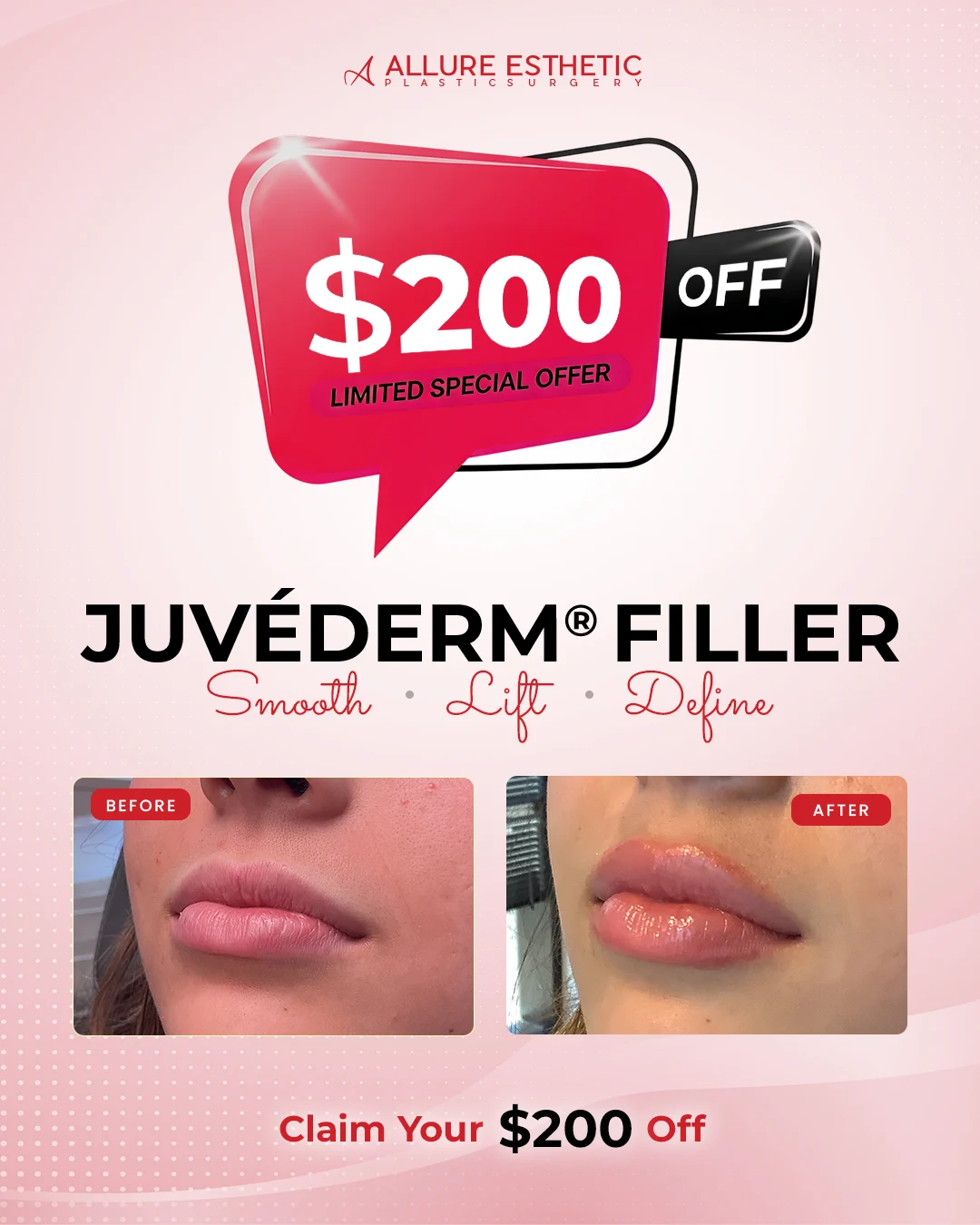 Juvederm Specials