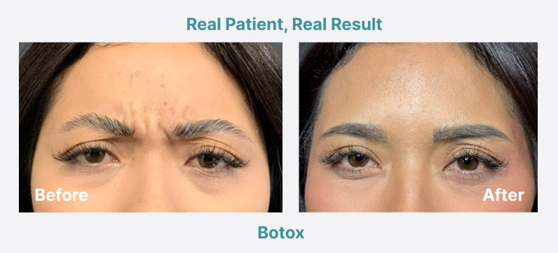 Botox Before/After Photo