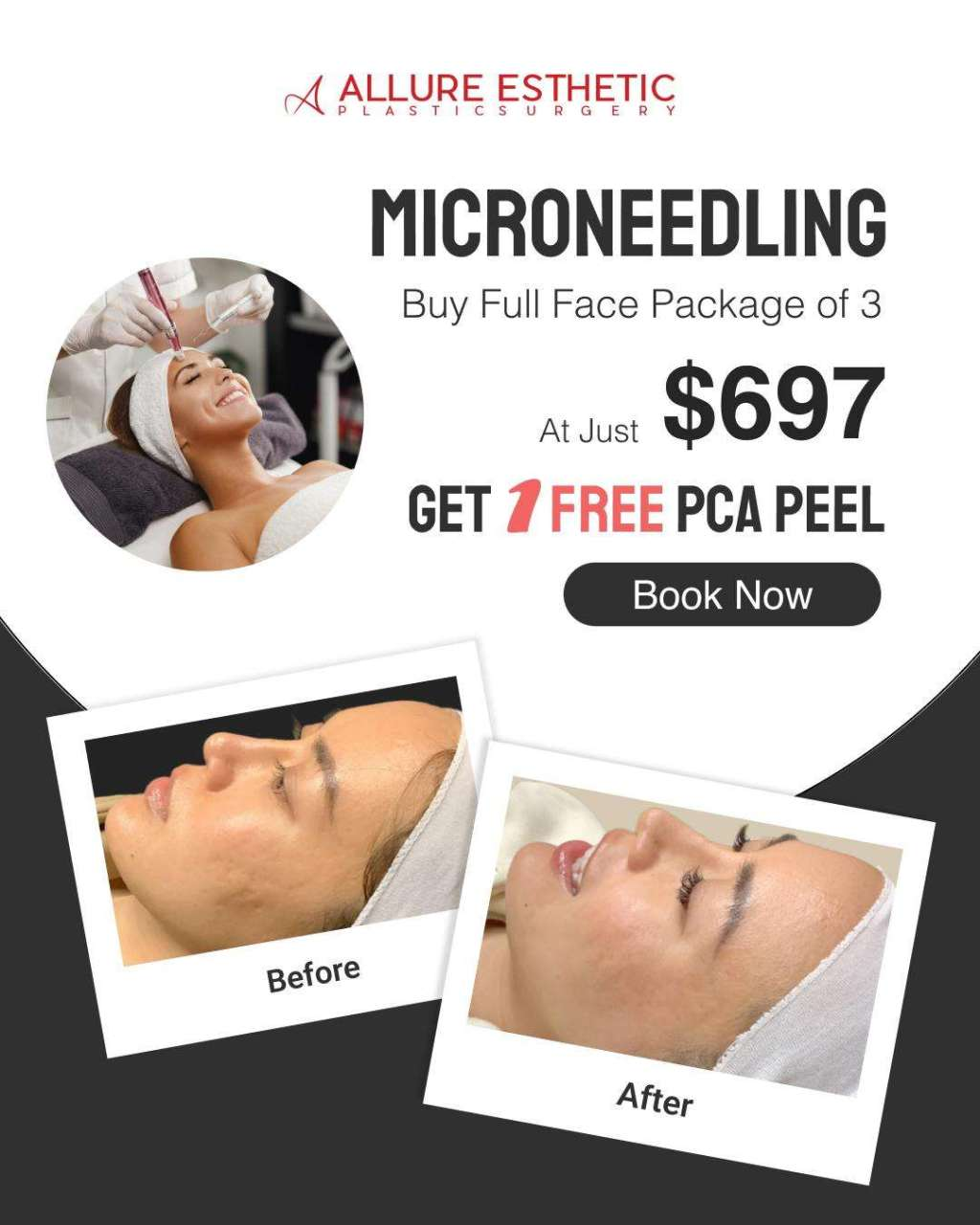 Microneedling Specials