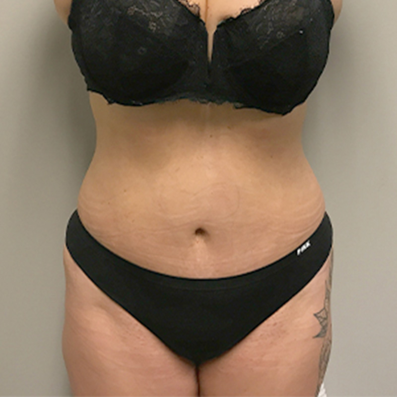 Abdominoplasty 01