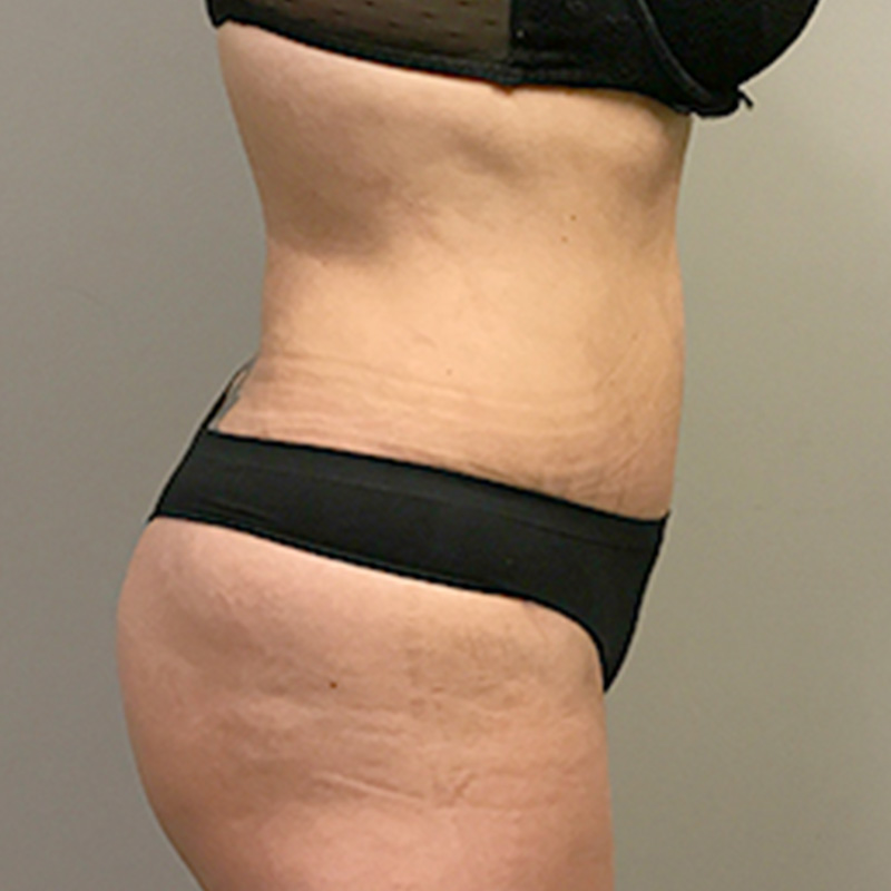 Abdominoplasty 05