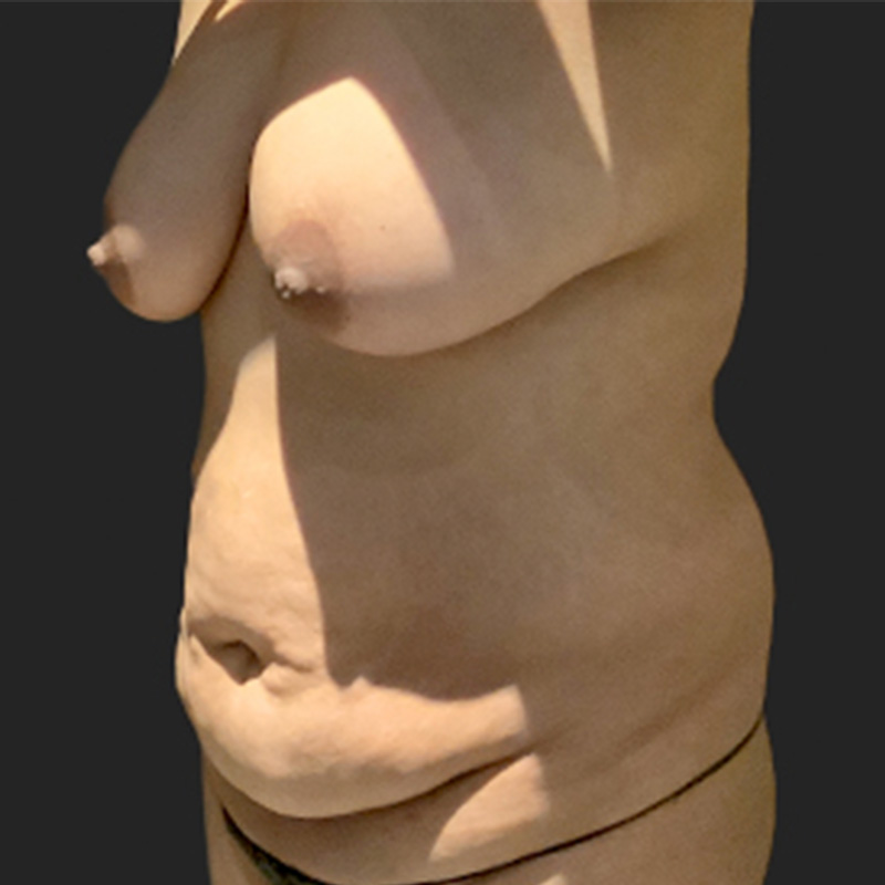 Abdominoplasty 03