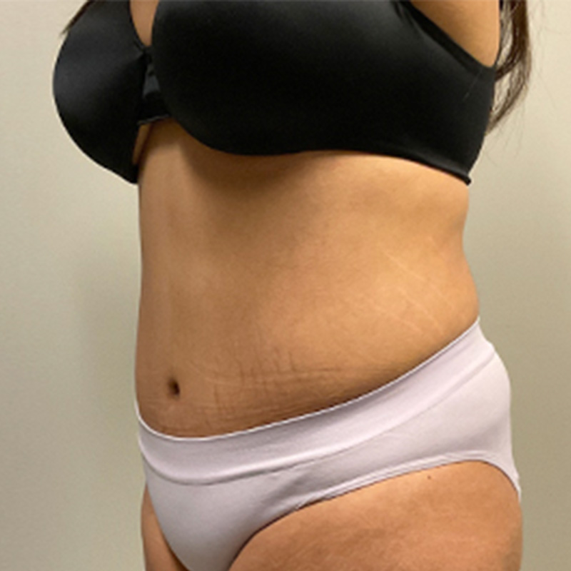 Abdominoplasty 03