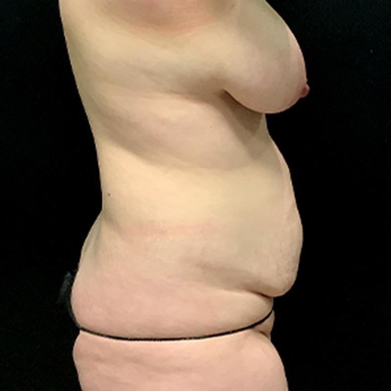 Abdominoplasty 05