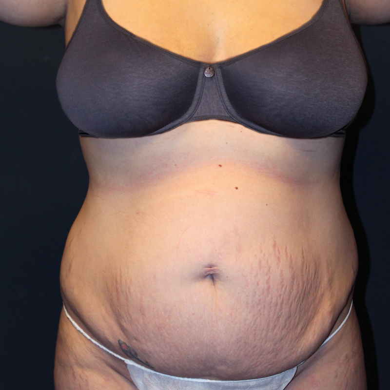 Abdominoplasty 01