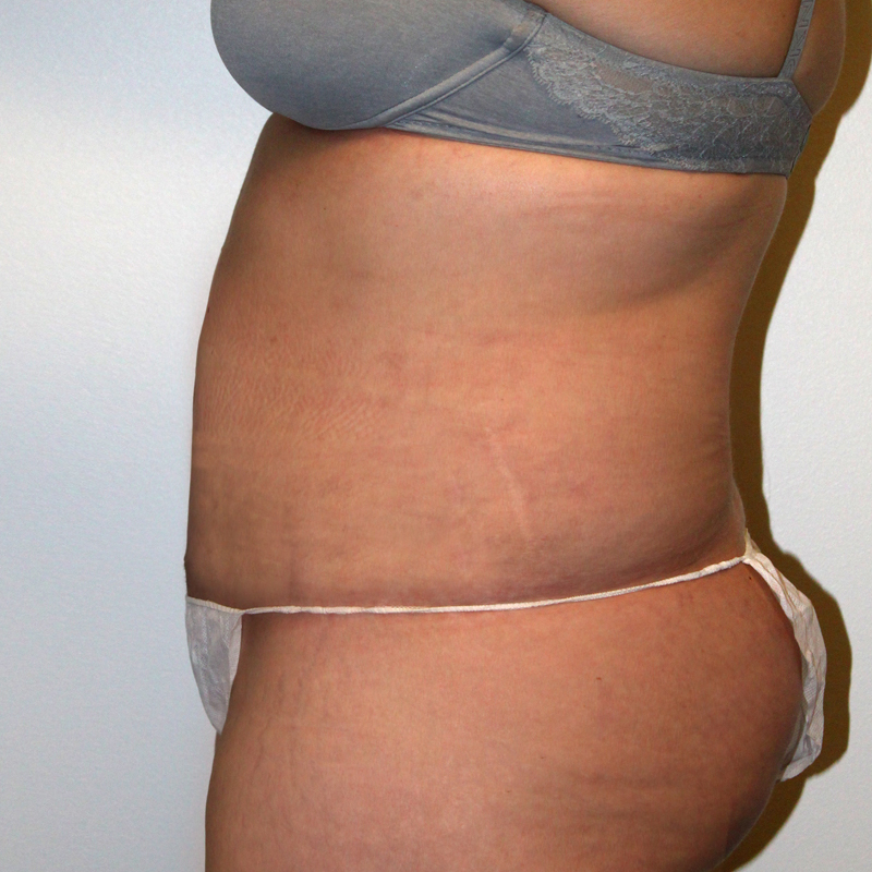 Abdominoplasty 03