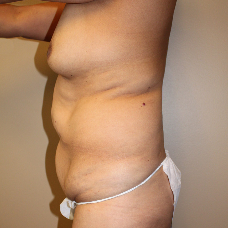 Abdominoplasty 03