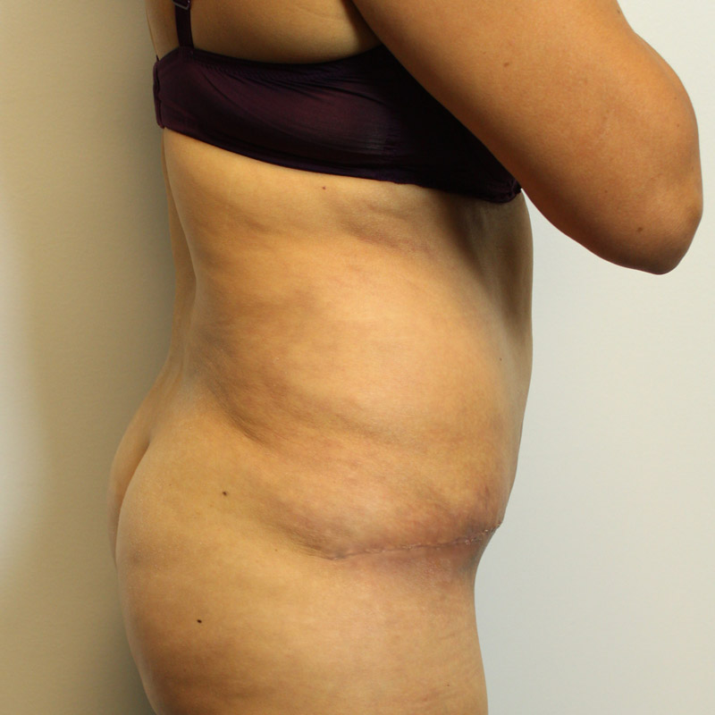 Abdominoplasty 05