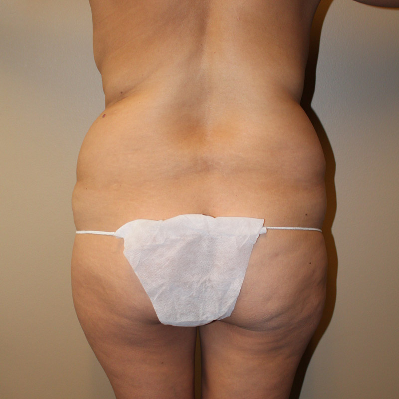 Abdominoplasty 07
