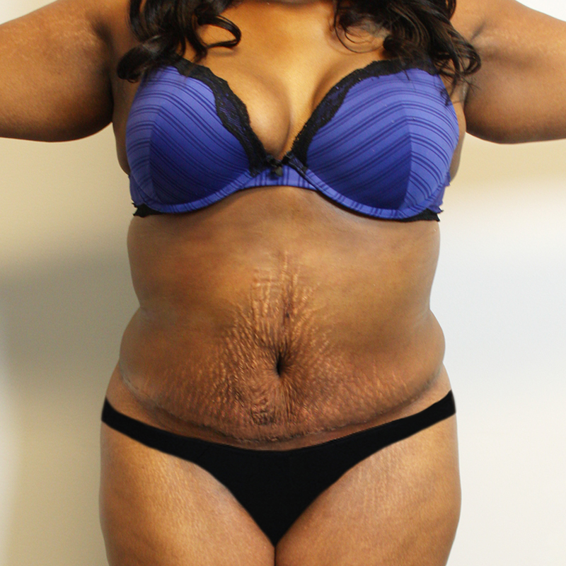 Abdominoplasty 14