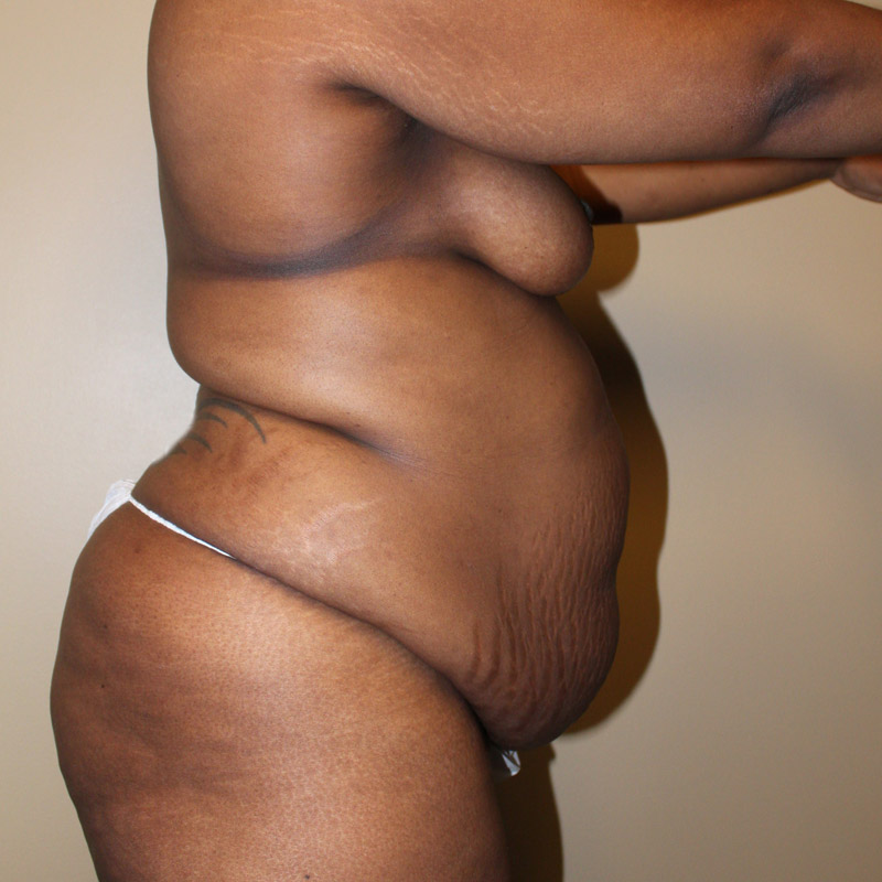 Abdominoplasty 07
